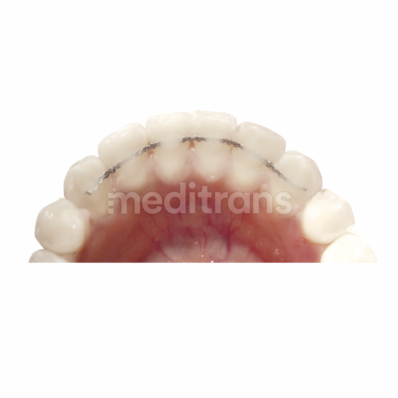 Retainer stalowy PROCLINIC EXPERT płaski skręcany z 8 nitek 91cm